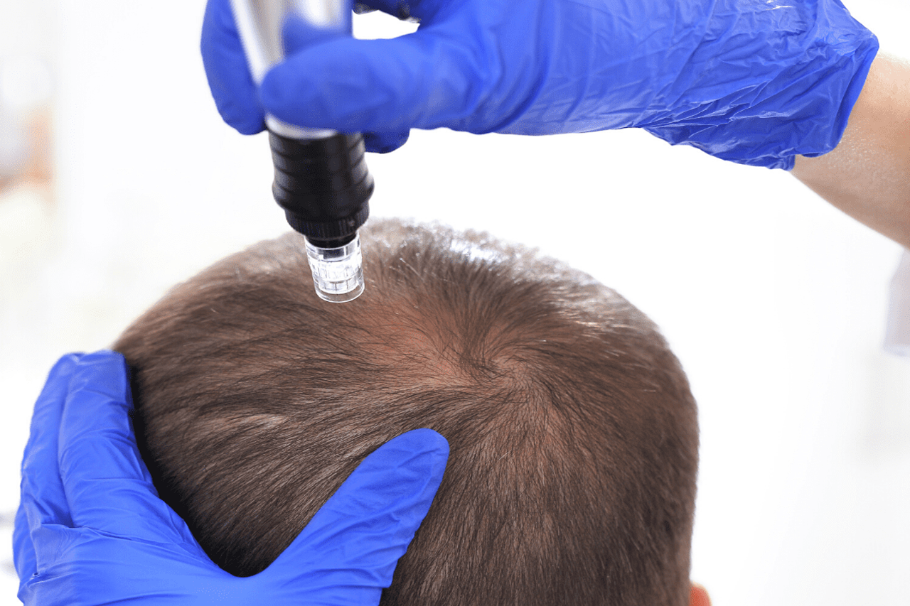prp therapy for hair fall